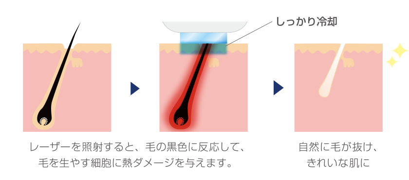 ダイオードレーザー脱毛の仕組み